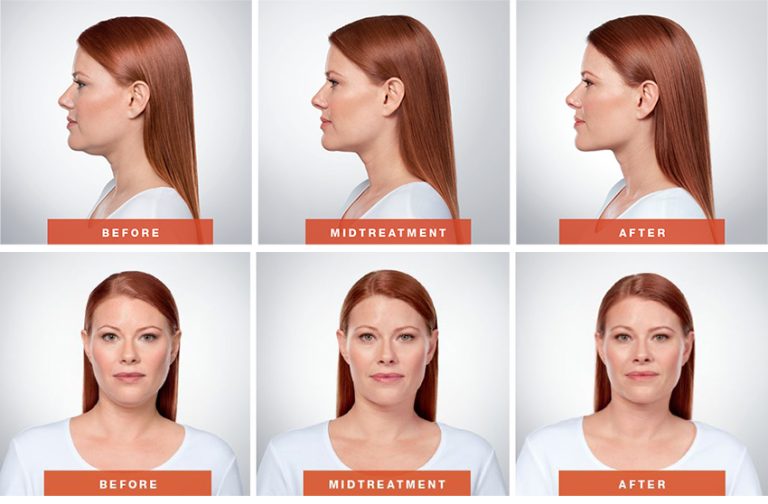 kybella-768x504